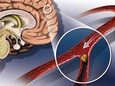 Закупорка сосудов мозга, инсульт (схема). Источник - http://www.likar.info/